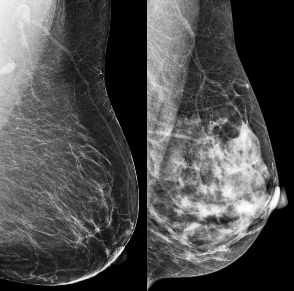 dense-breast-cancer-cdc.jpg