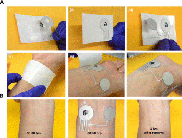 Assembly and the transfer process of the ISF glucose wearable patch